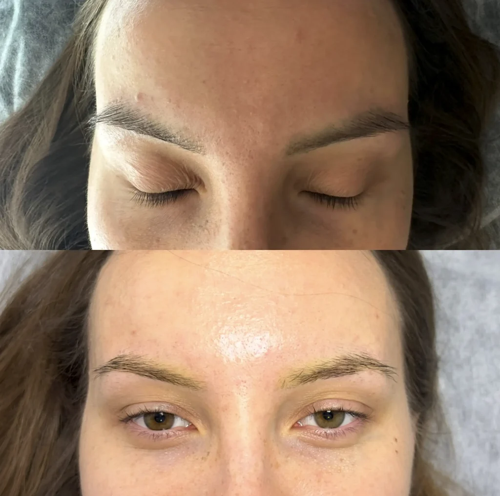 Eyebrow Tattoo Removal