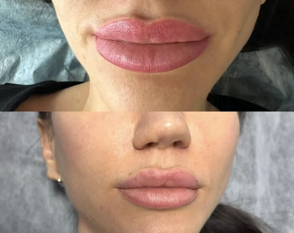 Saline tattoo removal