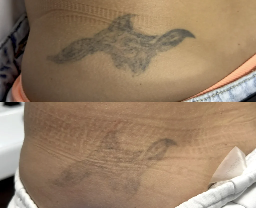 Saline vs. Laser Methods