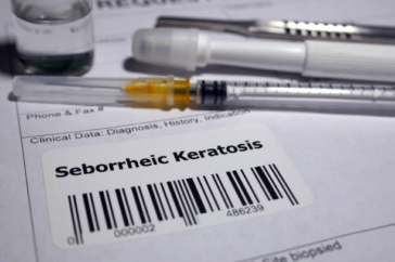 Seborrheic Keratosis Removal: DIY Methods and Precautions