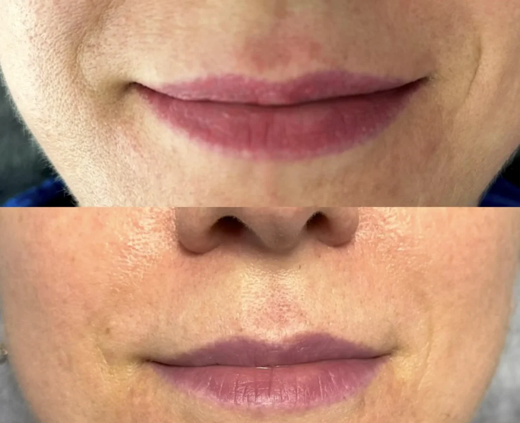 lip tattoo removal