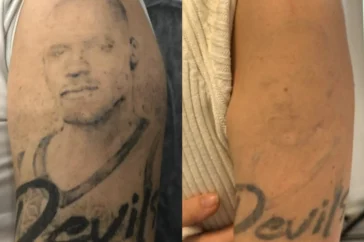 remove tattoo