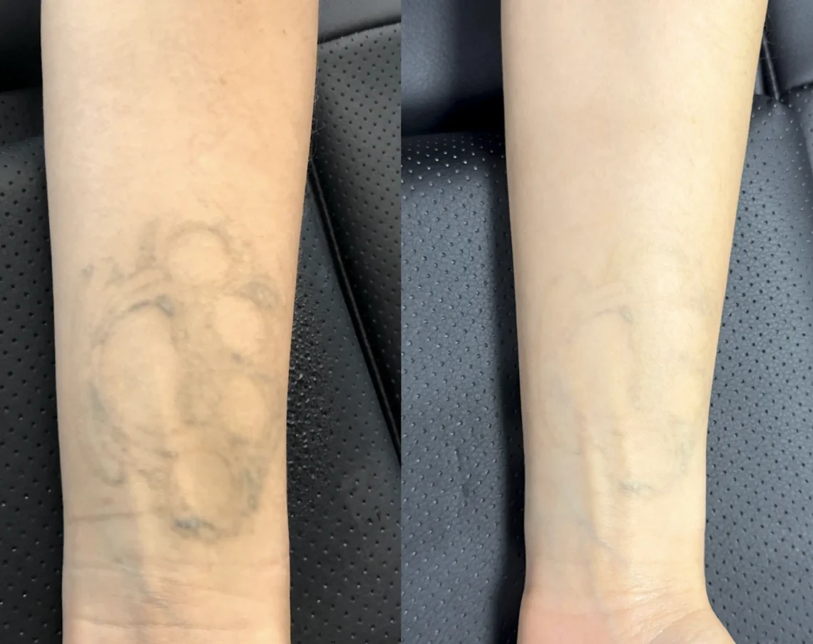 saline tattoo removal before and after