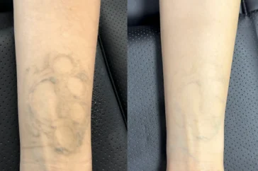 saline tattoo removal before and after