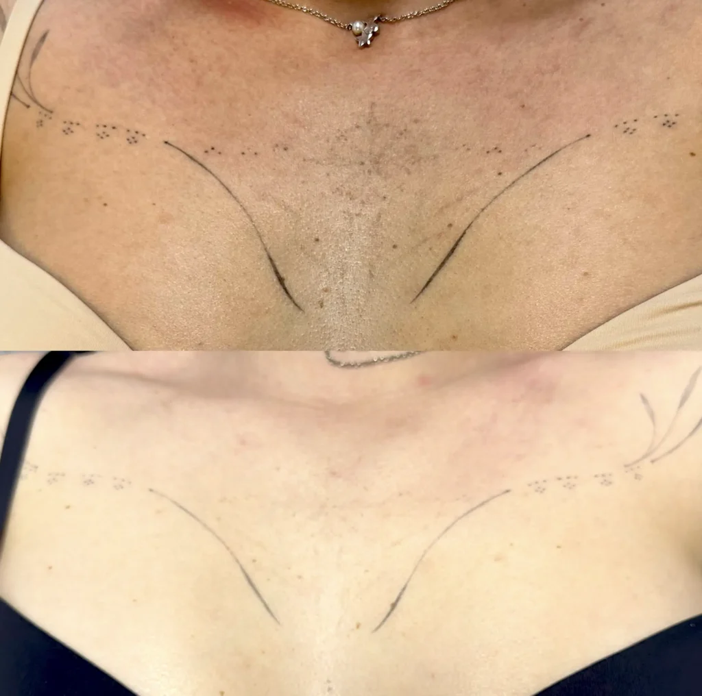 saline tattoo removal brisbane