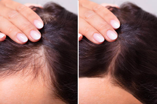 Hair Loss Treatments: Effective Solutions for Thinning Hair